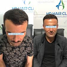 6 Ay Sonra Ki Degisim Maksimum Greft Sac Ekimi Ve Profesyonel Ekip Ile Emin Ellerdesiniz Bizi Tercih Eden Hastamiza Tesekkur Eder Yen Hair Clinic Hair Clinic