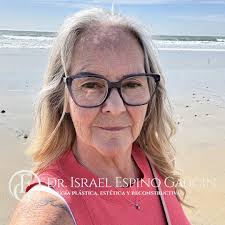 EleganceInEveryStage One of the most important aspects of facial  rejuvenation is seeing the real progress in the early days. Today, I had  the pleasure of seeing my 65-year-old patient