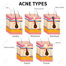 Pimple Diagram Area Wiring Diagrams