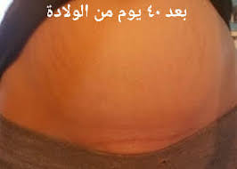 الولاده القيصريه التجميليه الآثار Dr Rabih Fakih Obgyn Clinic العيادة النسائية 70678004 Facebook