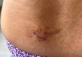 Image result for Lichen Simplex Chronicus