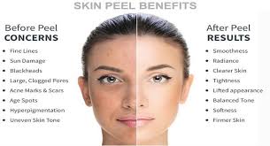 Image result for facial peel