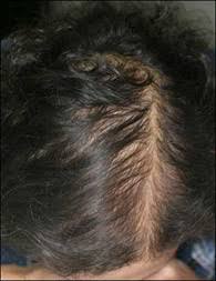 Par exemple, l'alopécie fibrosante frontale, qui touche principalement les. Chute De Cheveux Et Perte De Cheveux Alopecie Traitement