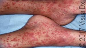 The term purpura is usually used to refer to a skin rash in which small spots of blood appear on the skin. A 42 Year Old Man With Skin Petechia And Palpable Purpura On His Legs Journal Of Urgent Care Medicine