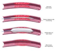 It involves the use of a catheter and a balloon to open up blocked arteries angioplasty. Angioplasty And Stent Placement Procedures Azura Vascular Care