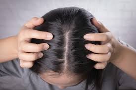 It can be the result of heredity, hormonal changes baldness typically refers to excessive hair loss from your scalp. Young Asian Women Worry About Problem Hair Loss Head Bald Dandruff 9382 93 Female Daily