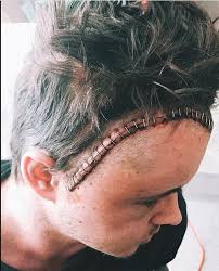 Check spelling or type a new query. Home And Away Star Johnny Ruffo S Brain Cancer Returns Amid Seizures And Excruciating Pain Celebrity News Showbiz Tv Express Co Uk