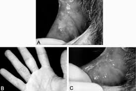Recalcitrant warts represent a frustrating challenge for both patients and physicians. Use Of Intralesional Interferon A For The Treatment Of Recalcitrant Oral Warts In Patients With Aids A Report Of 4 Cases Oral Surgery Oral Medicine Oral Pathology Oral Radiology And Endodontics