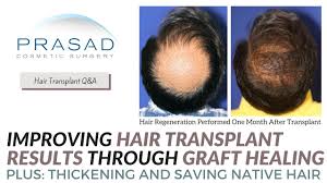 Shock loss involves the loss of follicles. How Shock Loss Affects Transplanted And Native Hair And Treatment To Improve Transplant Results Youtube
