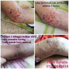 Kudis api dalam istilah perubatan dipanggil sebagai impetigo. Kudis Bernanah Pada Siku Akhirnya Sembuh Syukur Ilham Family Sihat