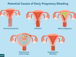 Spotting during pregnancy is a common concern that many pregnant women face. Does Early Pregnancy Bleeding Mean A Miscarriage