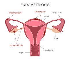 Carlo bulletti, maria elisabetta coccia, silvia battistoni. What Is Endometriosis Indian Center For Endometriosis Ice