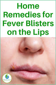 13 Natural Home Remedies For Fever Blisters On The Lips Fever Blister Remedy Home Remedies For Fever Blister Remedies