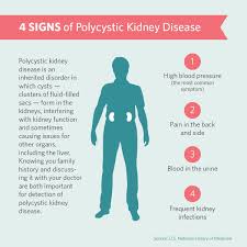 Symptoms Of Polycystic Kidney Disease