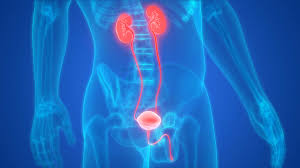 Bladder cancer can often be found early because it causes blood in the urine or other urinary symptoms that cause a person to see a health in most cases, blood in the urine (called hematuria) is the first sign of bladder cancer. Bladder Cancer Screening And Diagnosis Johns Hopkins Medicine