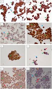 MIA PaCa-2 and PANC-1 – pancreas ductal adenocarcinoma cell lines with  neuroendocrine differentiation and somatostatin receptors | Scientific  Reports
