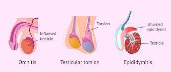 Testicular Trauma: Cause for Male Infertility?