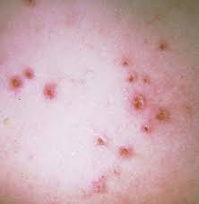 Image result for Demodex brevis