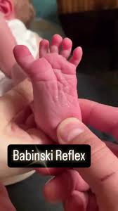 Image result for Babinski Reflex