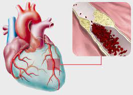 Douleurs thoraciques, essoufflement inhabituel, palpitations, malaises ou syncopes. Infarctus Du Myocarde Ou Crise Cardiaque Causes Symptomes Traitements