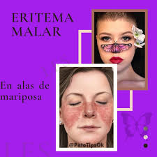 👋 Hola #PatoTippers . . 📣 Hoy les traigo unas imágenes del eritema  característico del Lupus Eritematoso Sistémico . . 🤔 Che Fran, este Rash  Malar es patognomonico del Lupus⁉️ La respuesta