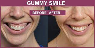 Studies show that gummy smiles become noticeable when 3mm or more of gums show when smiling. How To Fix Gummy Smile Correction With Best Treatment Blog Care Well Medical Centre