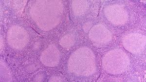 Lymphoma is a cancer that starts in cells that are part of the body's immune system. Lymphoma Action Types Of Lymphoma