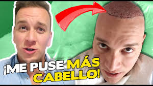 ¡ME HICE UN 2do TRASPLANTE DE CABELLO! 😱