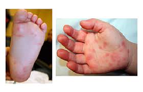 The characteristic red, spotted (petechial) rash of rocky mountain spotted fever is usually not seen until the sixth day or later after onset of symptoms, but this a small percentage of men and women develop small hard nodules called keratoderma blennorrhagicum on the soles of the feet and, less. What Are Those Bumps On My Child S Skin