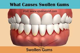 swollen gums home remes to get rid