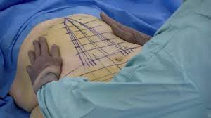 In this procedure, the skin is pulled downward and inward toward the center of the abdomen. Massive Weight Loss Tummy Tuck Fleur De Lys Youtube