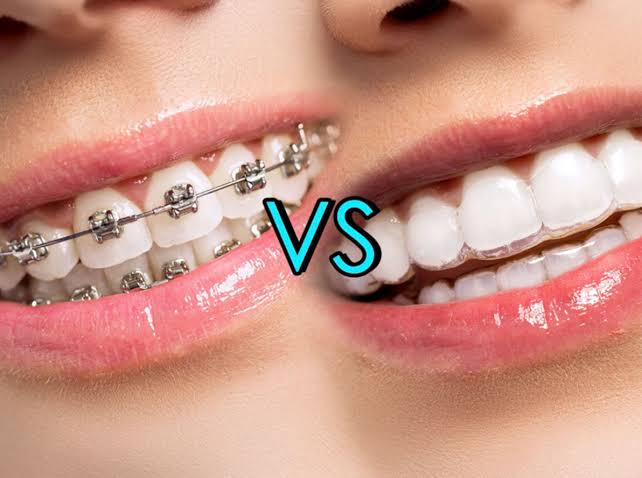 Braces vs. Invisalign – Which Is Right for You? The Orthodontic Centre