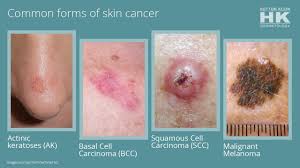 Melanoma, the deadliest skin cancer, can show up as a stripe black line on nails. Skin Cancer Specialist San Juan Capistrano Ca Hk Dermatology Dermatology Clinic