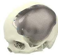 Cranial Implants Titanium – Xilloc Medical