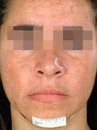Double-blind comparative study of hydroquinone and ursine grape extract in  the treatment of melasma