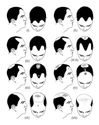 Norwood Scale Procerin For Male Hair Loss