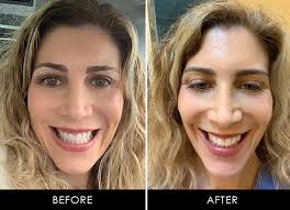 The beautiful smile is created by the jaws that developed forwards in the face and teeth positioned. Smiledirectclub Giveaway My Teeth Straightening Success Story Fountainof30 Com