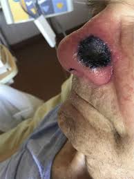 Sverzhevskiy scientific research institute for ear, nose, and throat diseases, moscow. On The Nose Disseminated Mucormycosis The American Journal Of Medicine