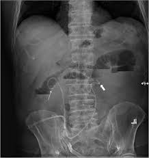 That pain can be caused by something as simple as lousy posture and sitting at your desk for too long. Abdominal And Pelvic Radiographs Of Medical Devices And Materials Part 2 Neurologic And Genitourinary Devices And Materials Abstract Europe Pmc
