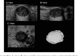 But radiologists can still see signs of cancer. Pdf Computer Aided Assessment Of Tumor Grade For Breast Cancer In Ultrasound Images Semantic Scholar