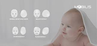 Image result for Positional Head Deformity