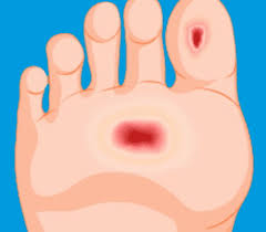 There are many aspects to this, but one you should never overlook is diabetic foot care. Diabetic Ulcers Alliance Vascular Institute