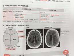 急性硬膜下血腫 急性硬膜外血腫 医学 硬膜 勉強