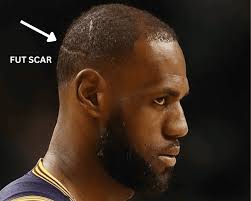 LeBron James Hair Transplant l Before and After
