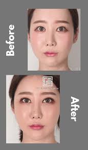 Check spelling or type a new query. How Much Does Double Eyelid Surgery Cost In Korea Cheaper Than Retail Price Buy Clothing Accessories And Lifestyle Products For Women Men