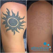 We did not find results for: Tatto Wallpapers San Diego Laser Tattoo Removal