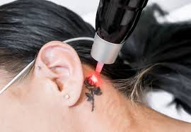 7312 e deer valley road building d, suite 105. 9 Tips For Tattoo Removal Cleveland Clinic
