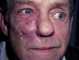 The clinical manifestations of syphilis are usually described according to stage of disease: Syphilis Images Dermnet Nz
