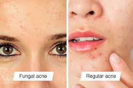 The treatment could take a few weeks to be effective. Fungal Acne Is Tricky To Diagnose And You Might Have It