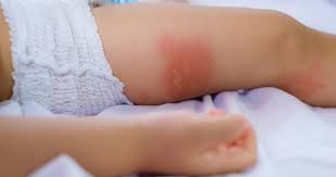 Aceste şuvoaie de apă amplasate printre pădurile ecuatoriale dense sunt o adevărată privelişte. Stafilococ Auriu La Nou NÄscuÈi Qbebe Ro